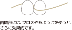 歯間部には、フロスや糸ようじを使うと、さらに効果的です。